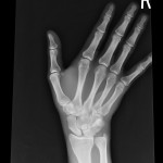 Hand Xray